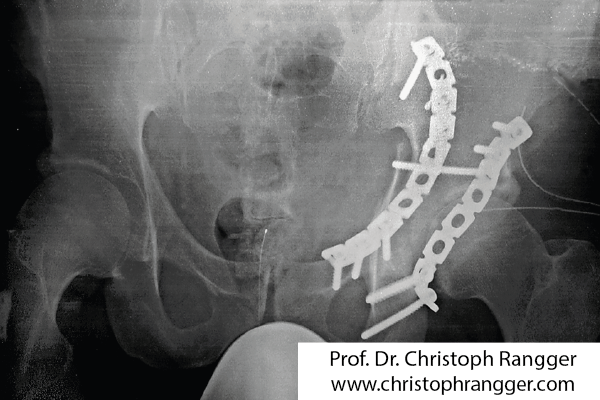 Hüftpannenbruch Operation von vorne und hinten - Prof. Dr. Christoph Rangger