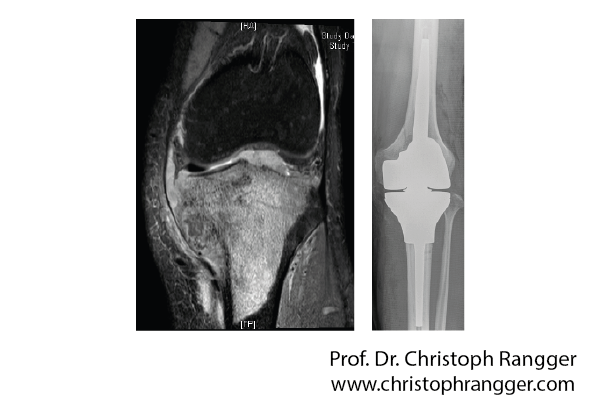 Knieprothese nach Knochentumor bösartig - Prof. Dr. Christoph Rangger