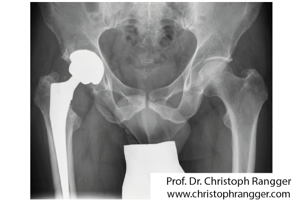 Zementfreie Hüftgelenksendoprothese - Prof. Dr. Christoph Rangger