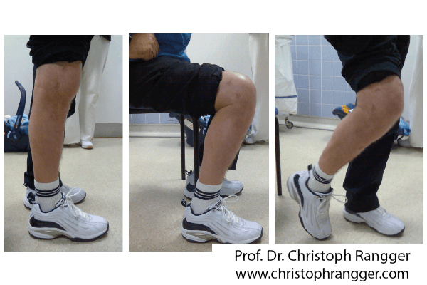 Превращение неподвижного коленного сустава в подвижный